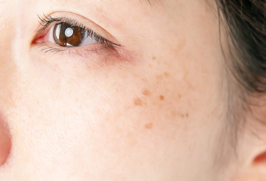 しみ・そばかす・美肌治療