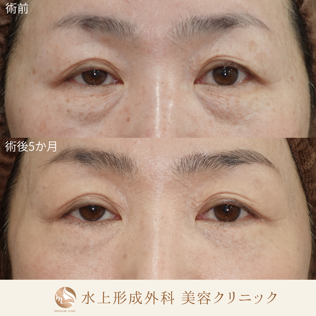 クマ取り（表ハムラ法）・汗管腫除去