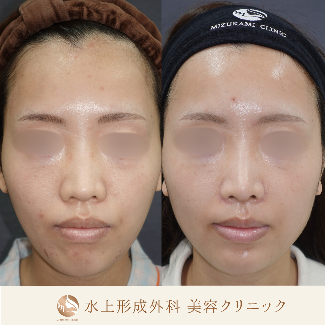 鼻フルコース（鼻中隔延長、鼻尖縮小、小鼻縮小外側法 、鼻翼基部プロテーゼ）