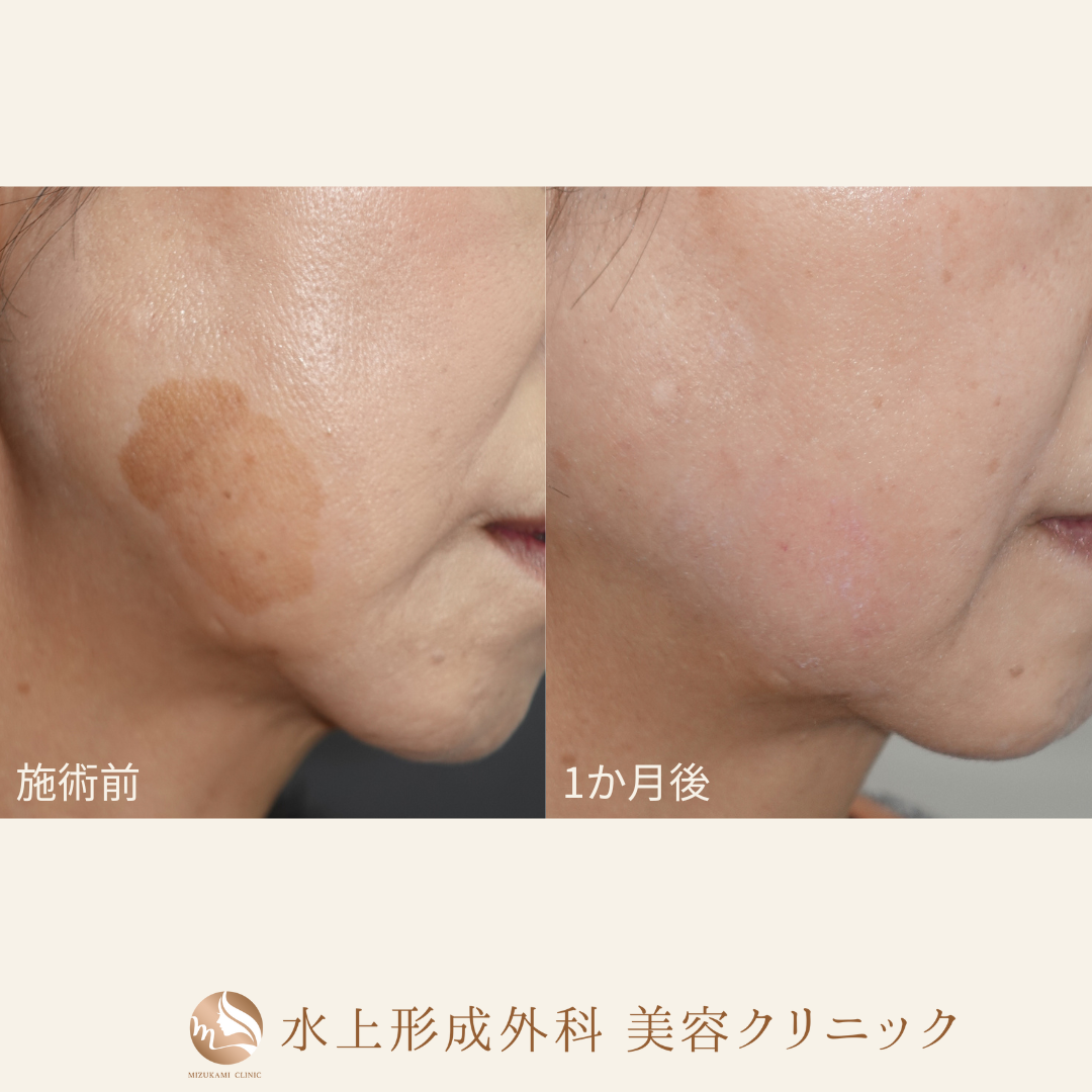 シミ取り（Qスイッチルビーレーザー）