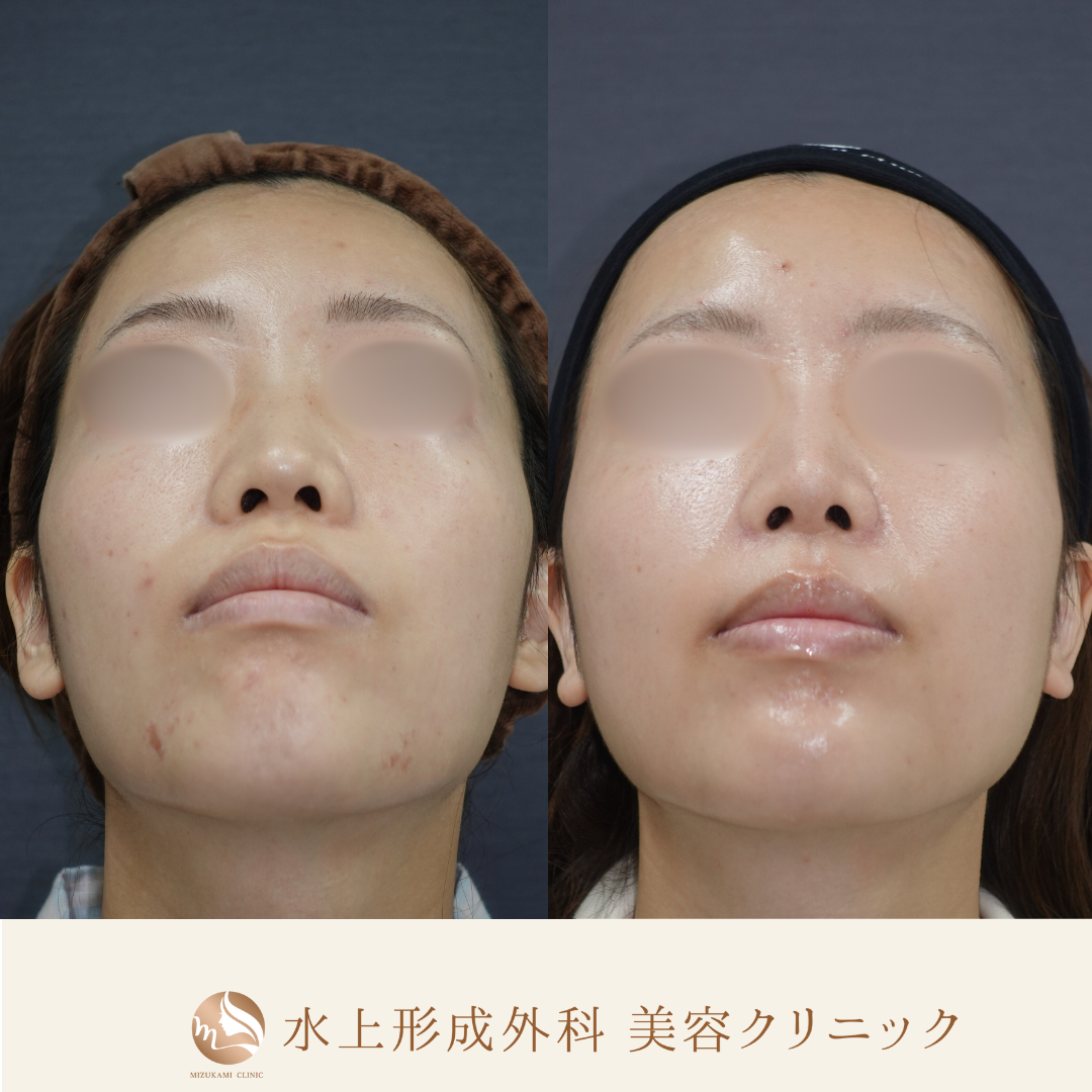 鼻フルコース（鼻中隔延長、鼻尖縮小、小鼻縮小外側法 、鼻翼基部プロテーゼ）の症例写真5