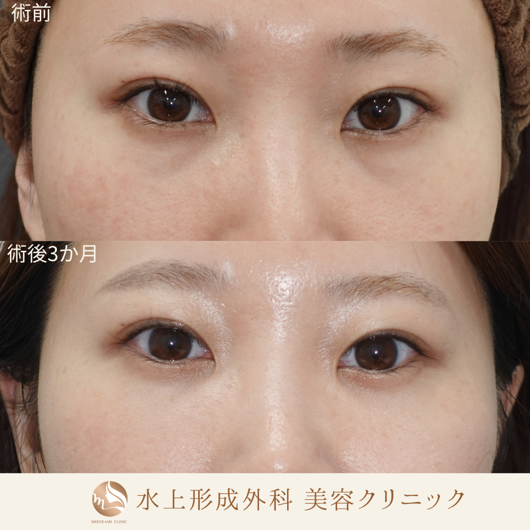 クマ取り（裏ハムラ）