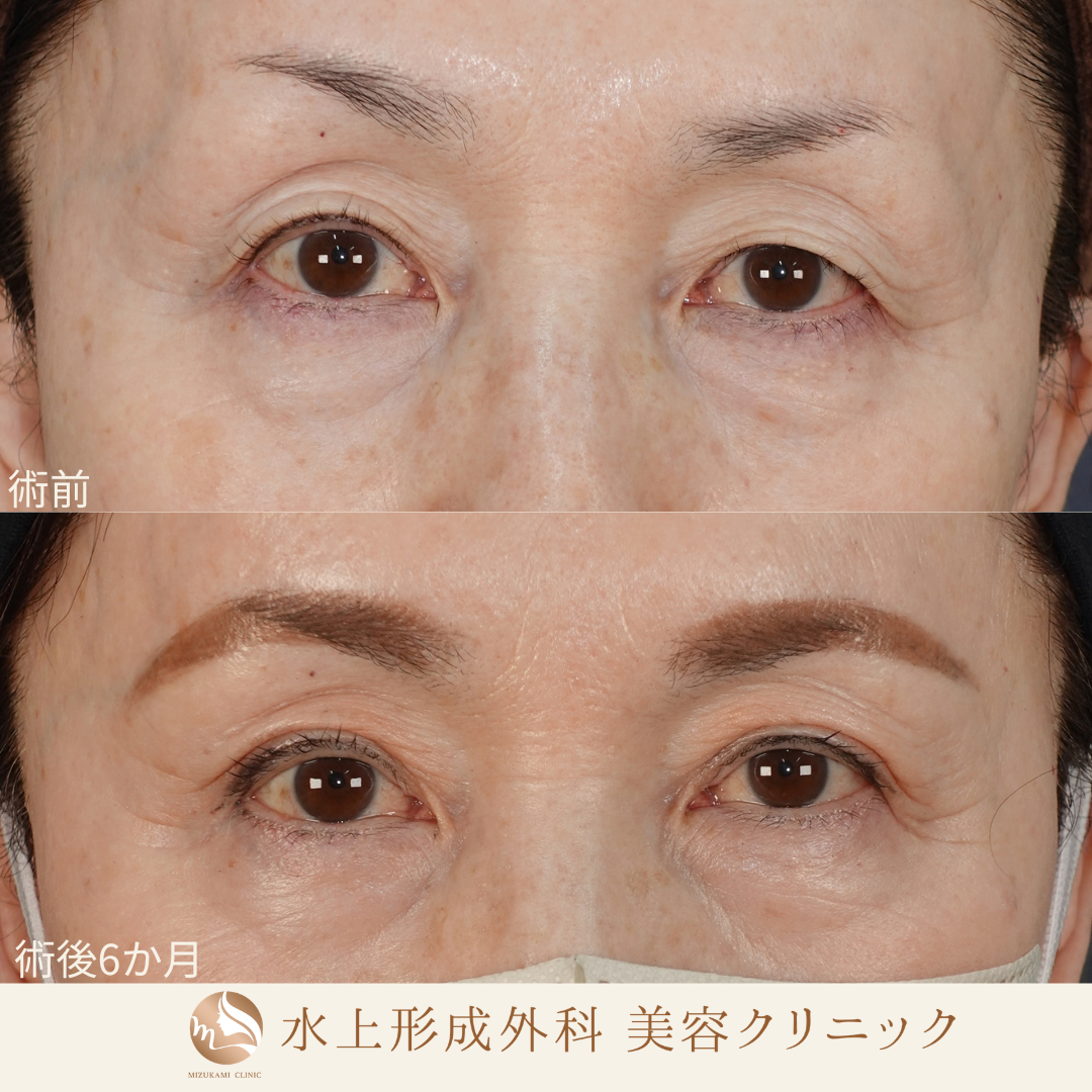 眼瞼下垂症手術