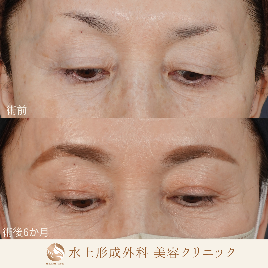 眼瞼下垂症手術の症例写真2