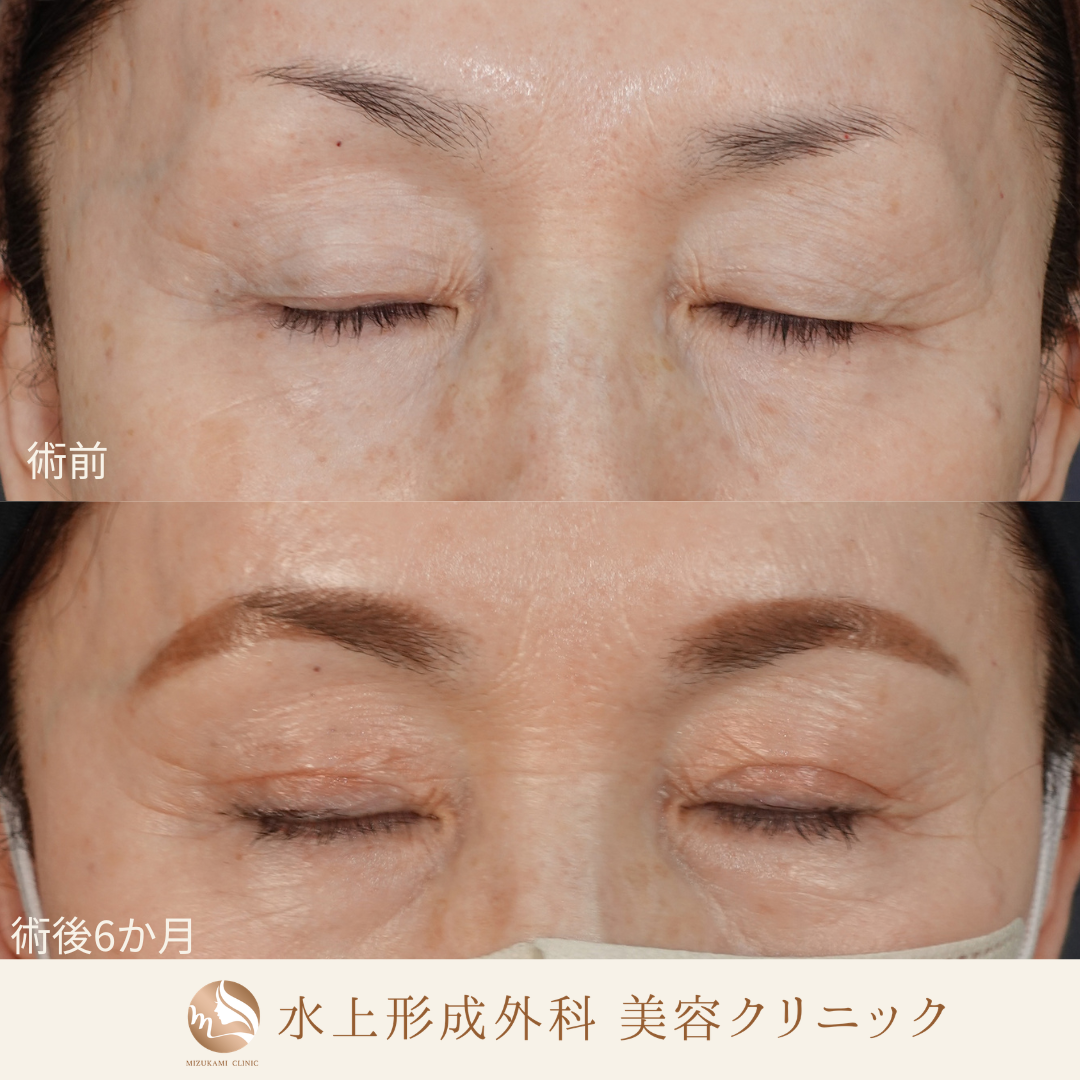 眼瞼下垂症手術の症例写真3