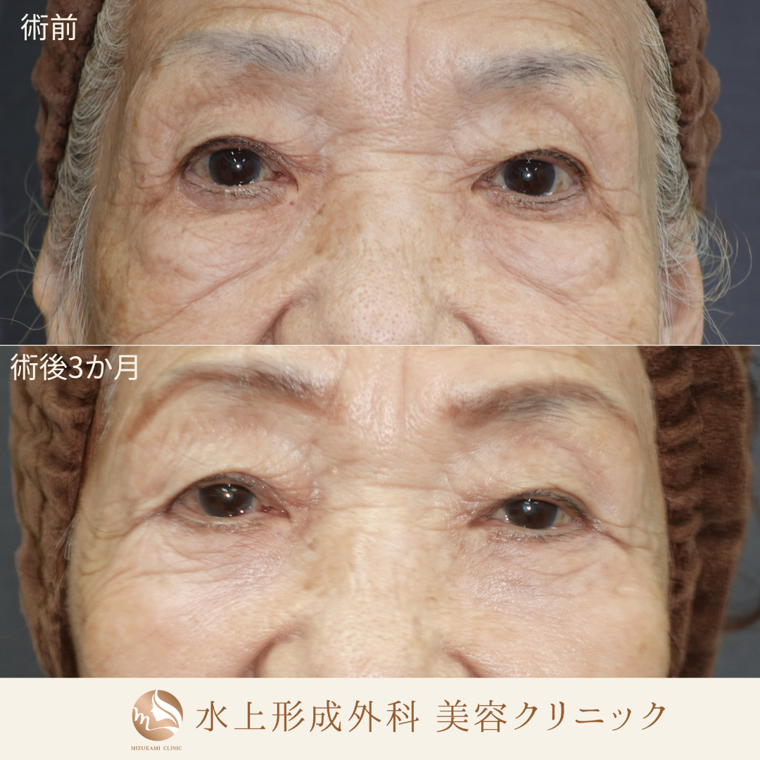 クマ取り（表ハムラ法）中顔面リフト（ミッドフェイスリフト）の症例写真3