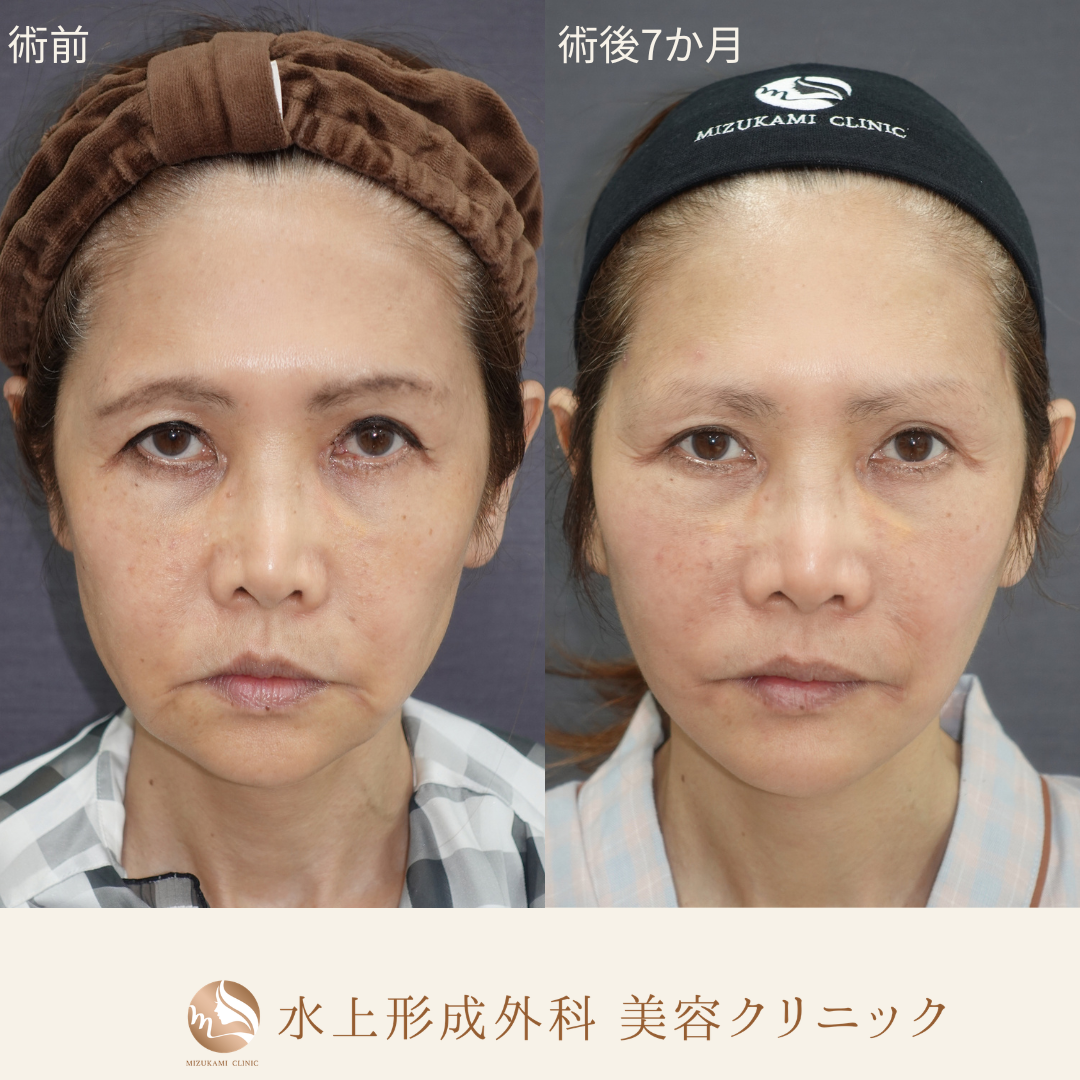 切開フェイスリフト（Deep Plane Facelift）の症例写真5