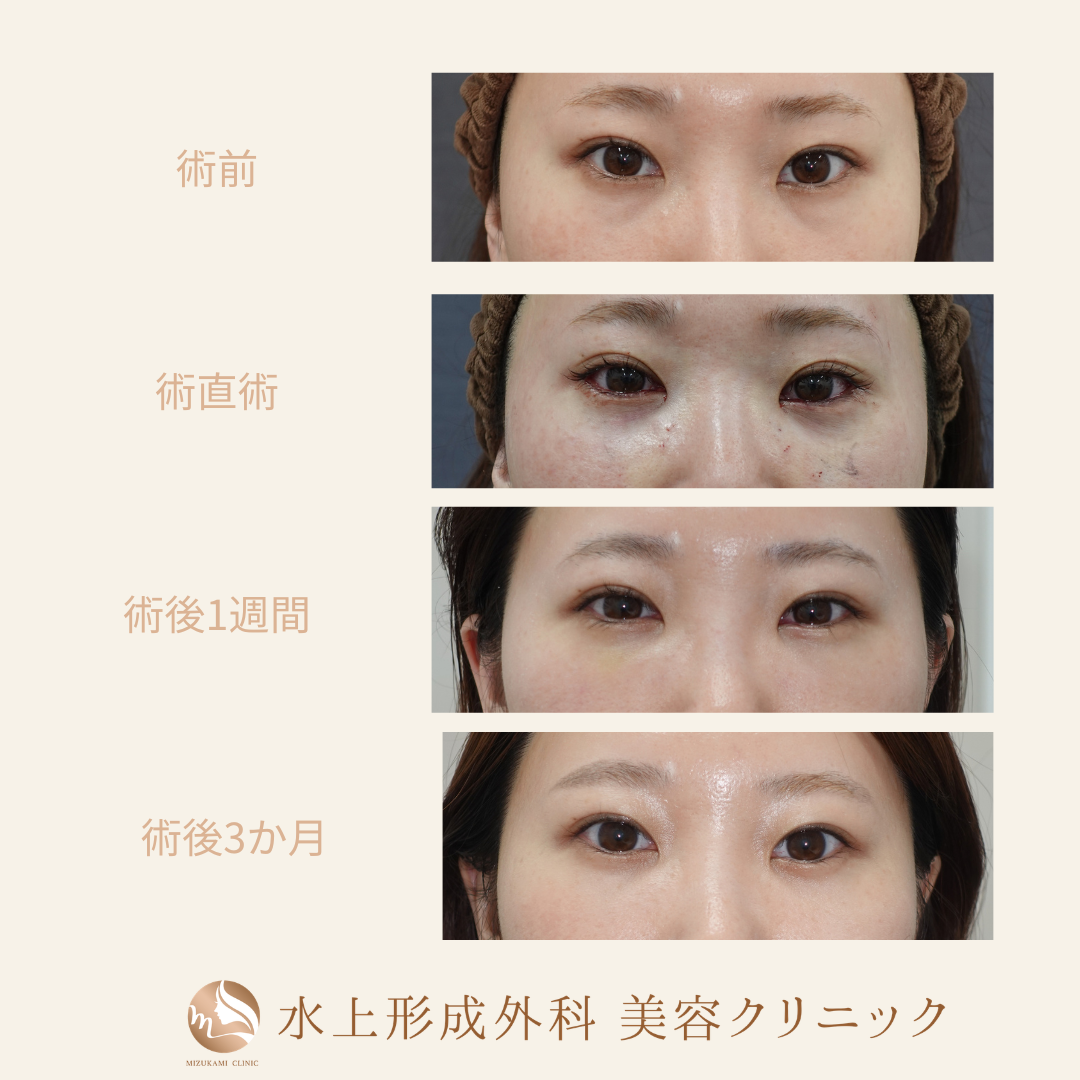 クマ取り（裏ハムラ）の症例写真4