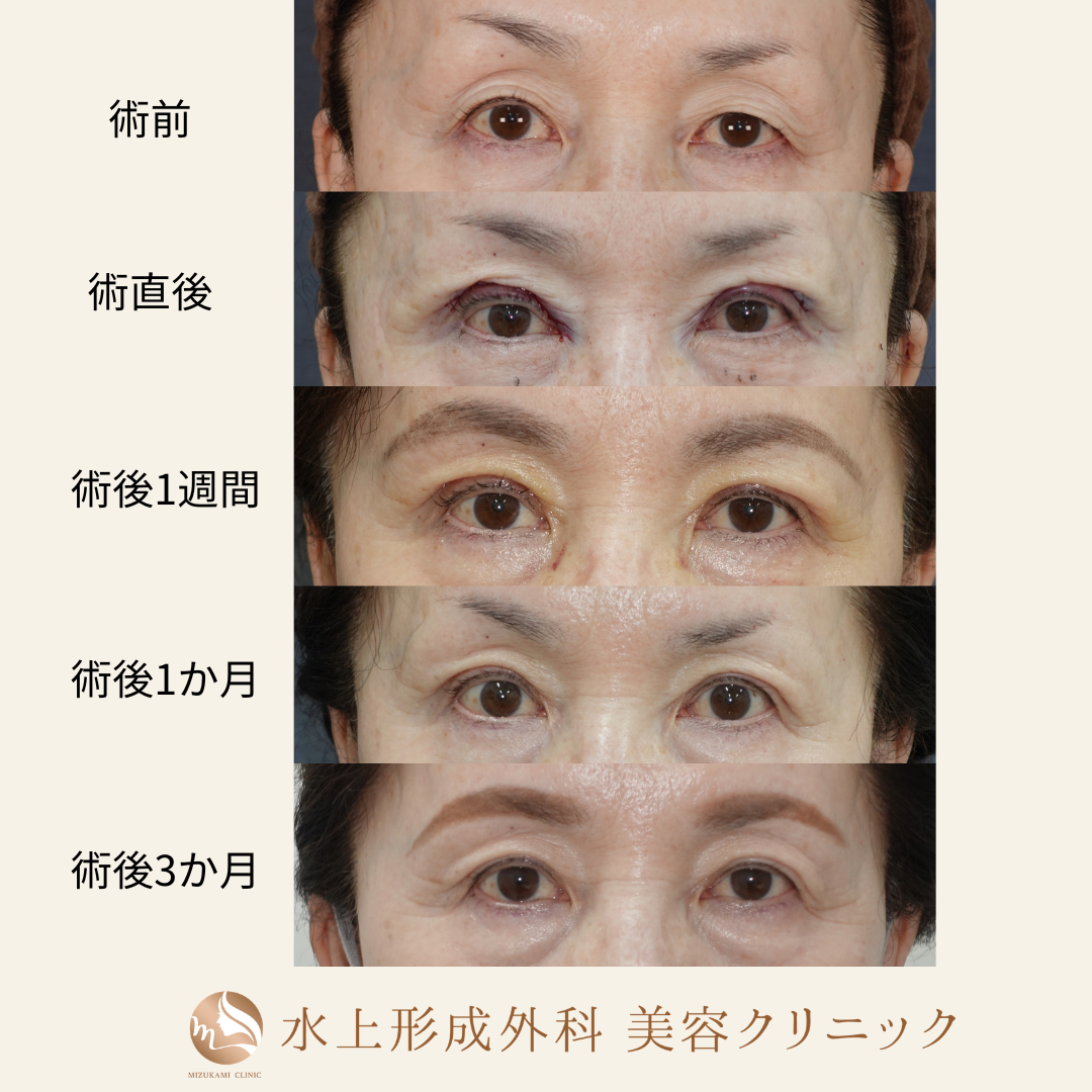 眼瞼下垂症手術の症例写真4