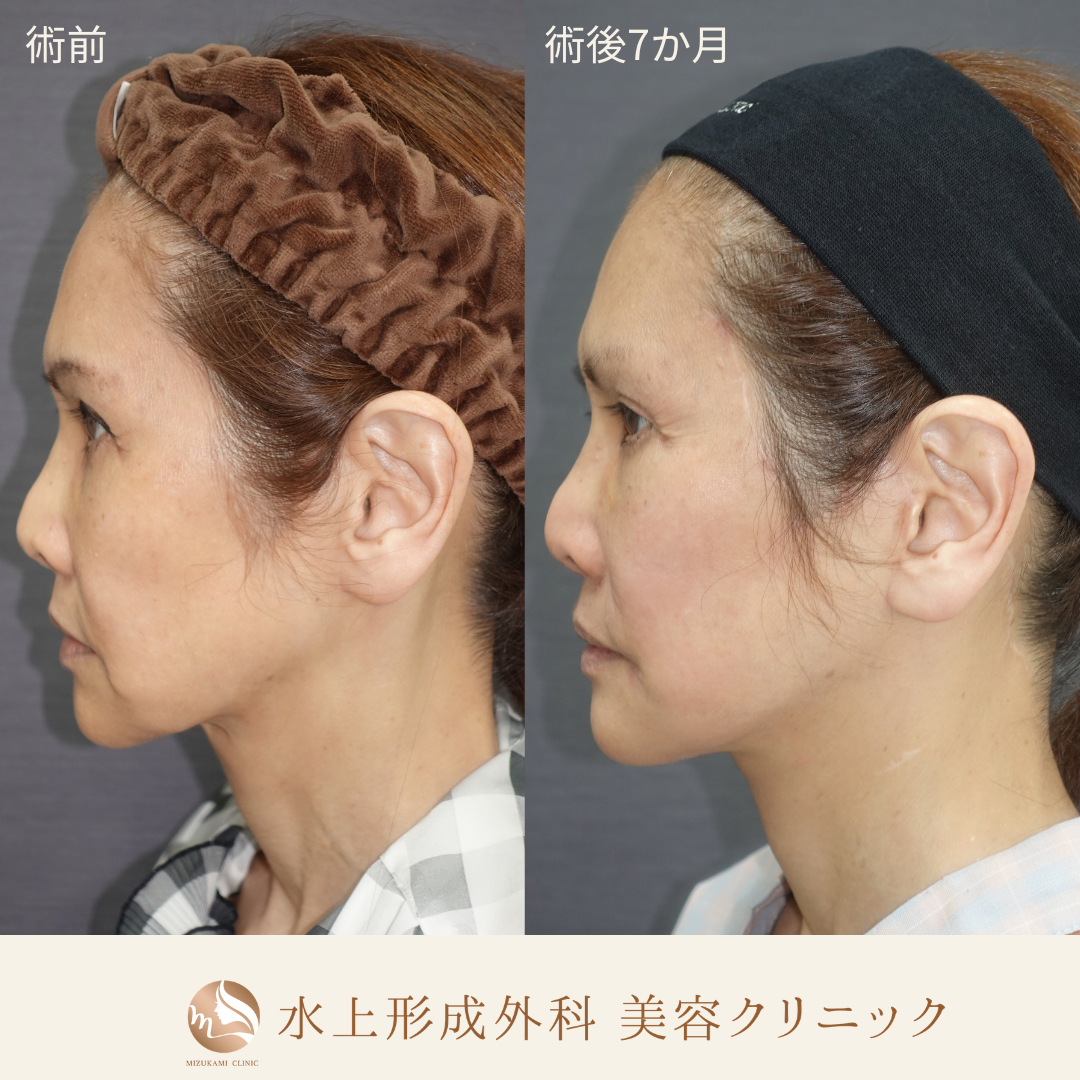 切開フェイスリフト（Deep Plane Facelift）の症例写真2