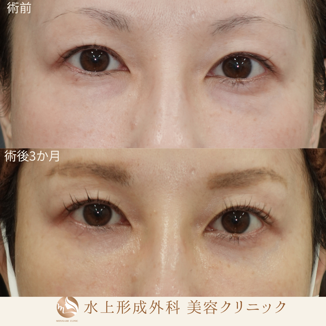 クマ取り（裏ハムラ）