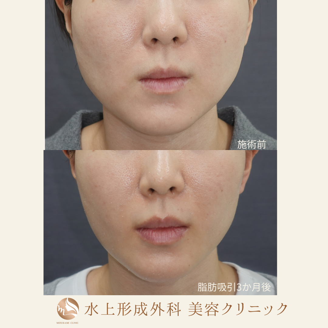 頬脂肪吸引＋エラボトックス