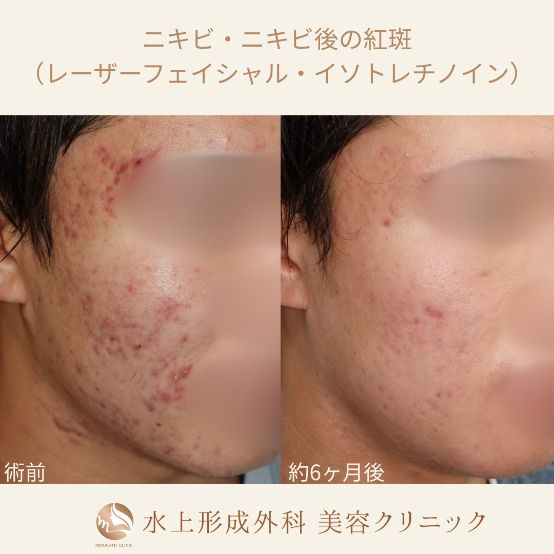 ニキビ・ニキビ痕（レーザーフェイシャル カスタマイズ・イソトレチノイン）