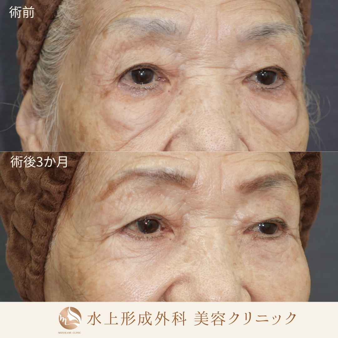 クマ取り（表ハムラ法）中顔面リフト（ミッドフェイスリフト）