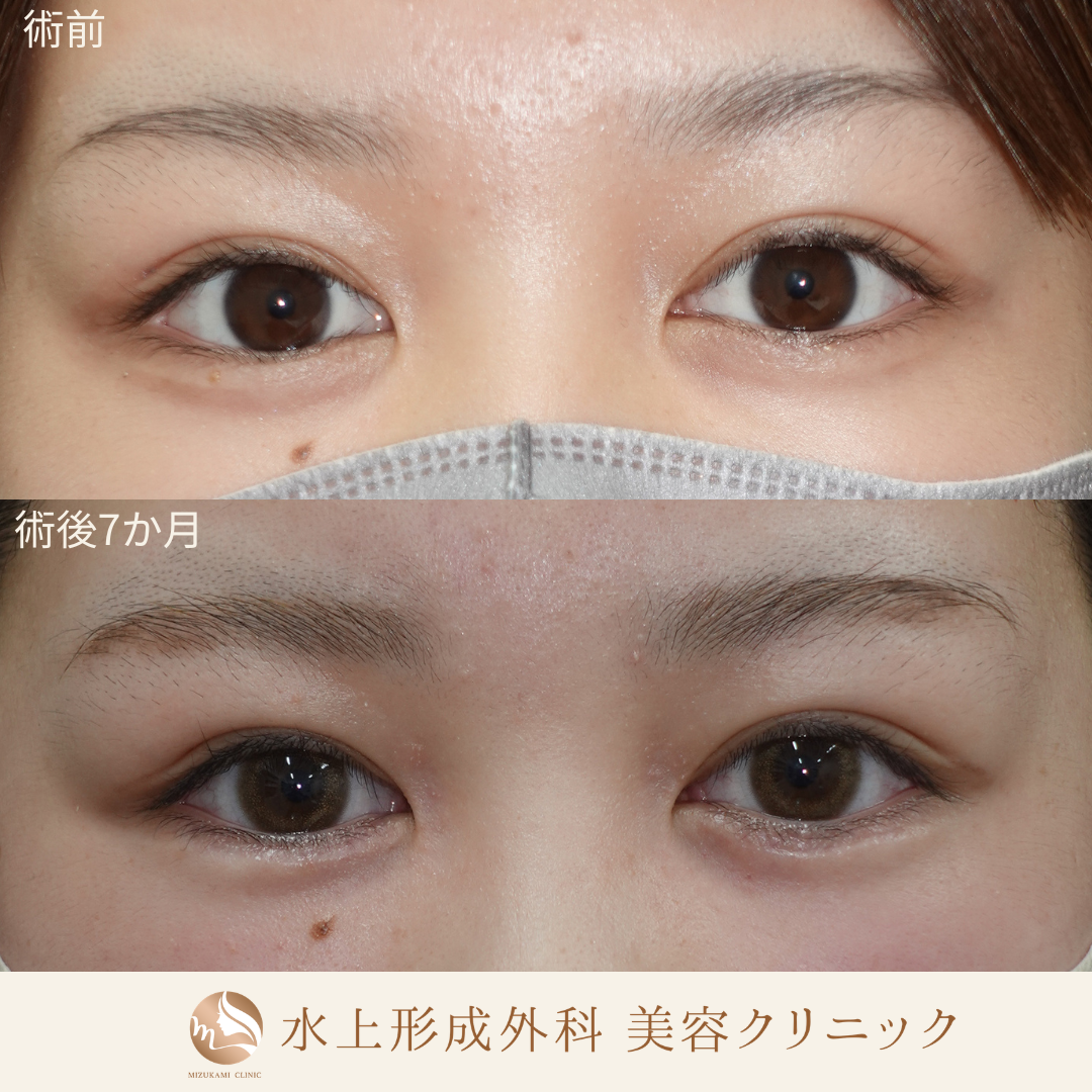 逆さまつ毛・睫毛内反症手術