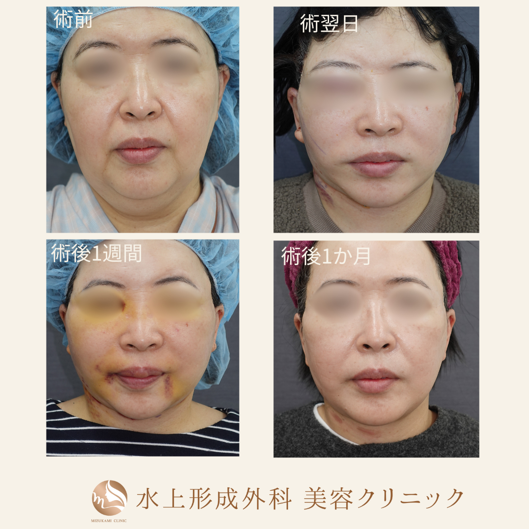 切開フェイスリフト・ペリカン手術の症例写真5