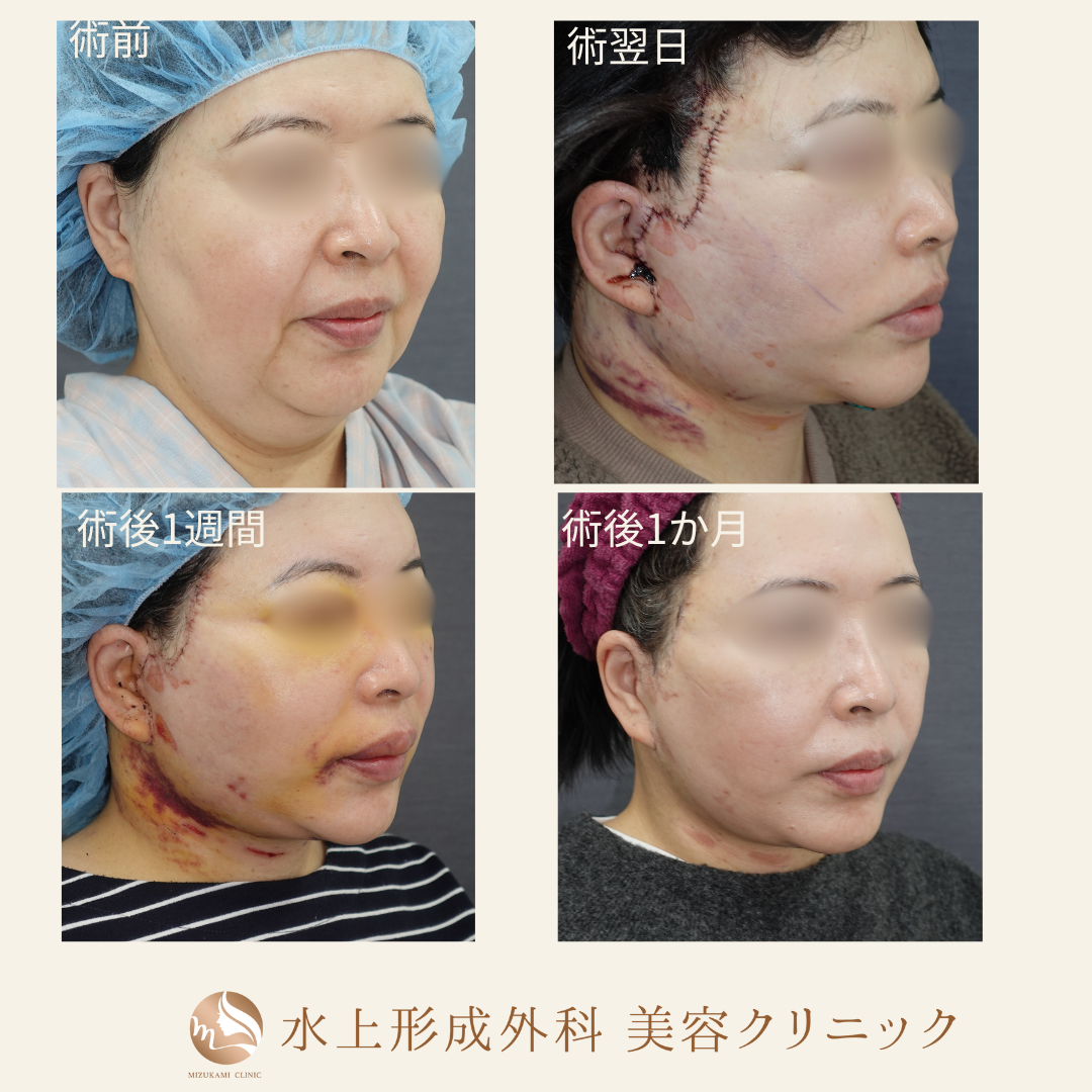 切開フェイスリフト・ペリカン手術の症例写真4