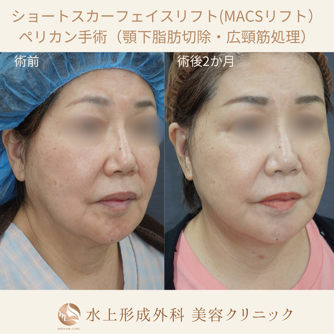 ショートスカーフェイスリフト・ペリカン手術