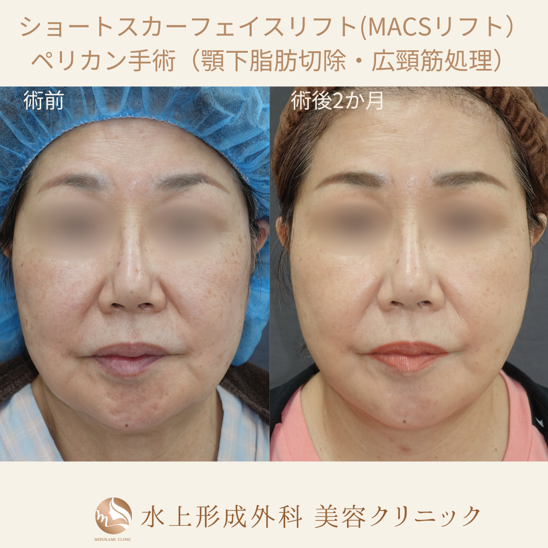 ショートスカーフェイスリフト・ペリカン手術の症例写真2