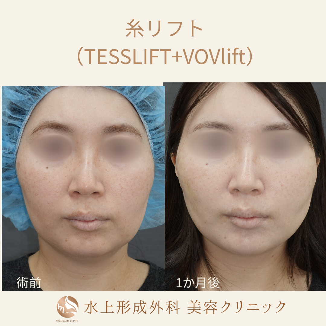 糸リフトの症例写真2