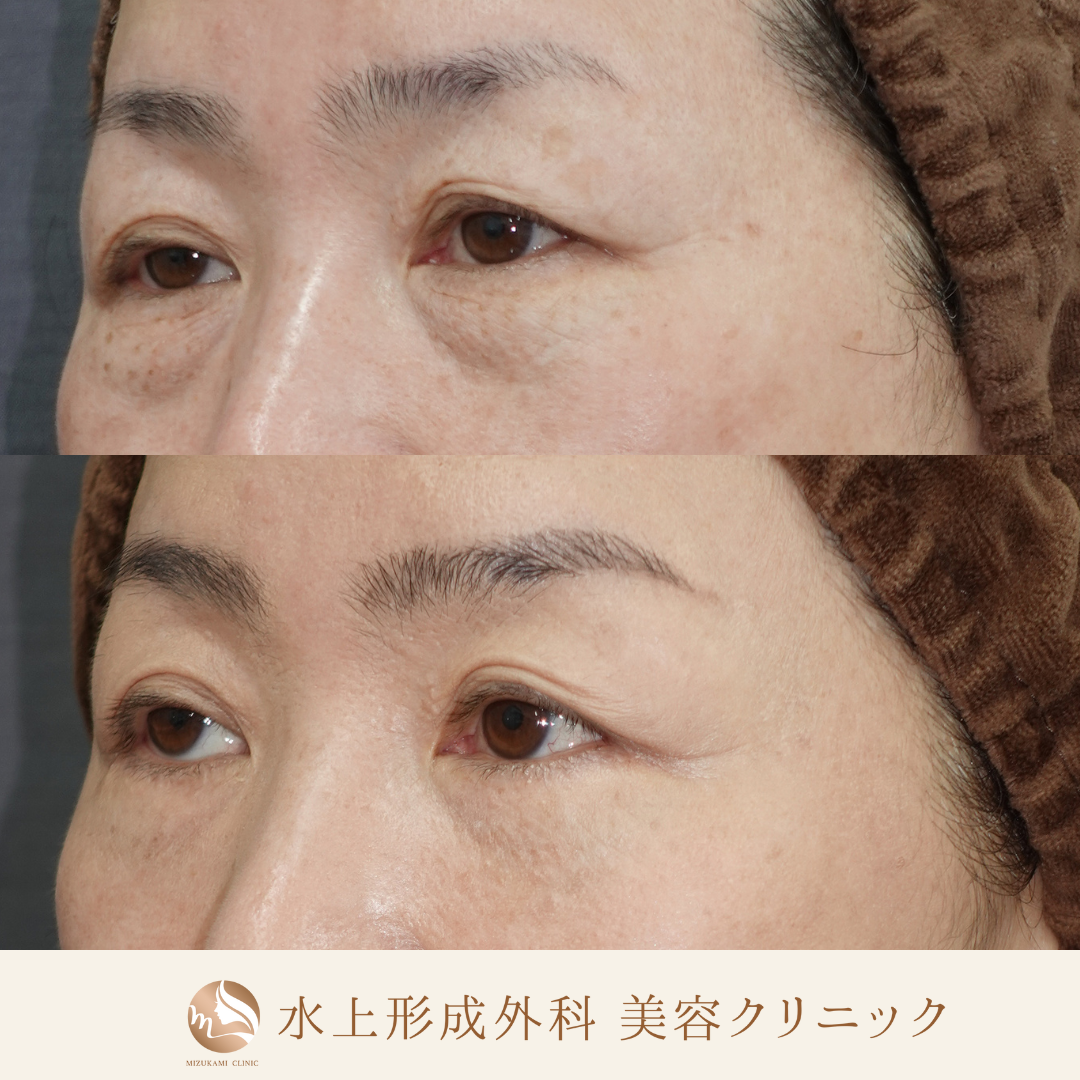 クマ取り（表ハムラ法）・汗管腫除去の症例写真2