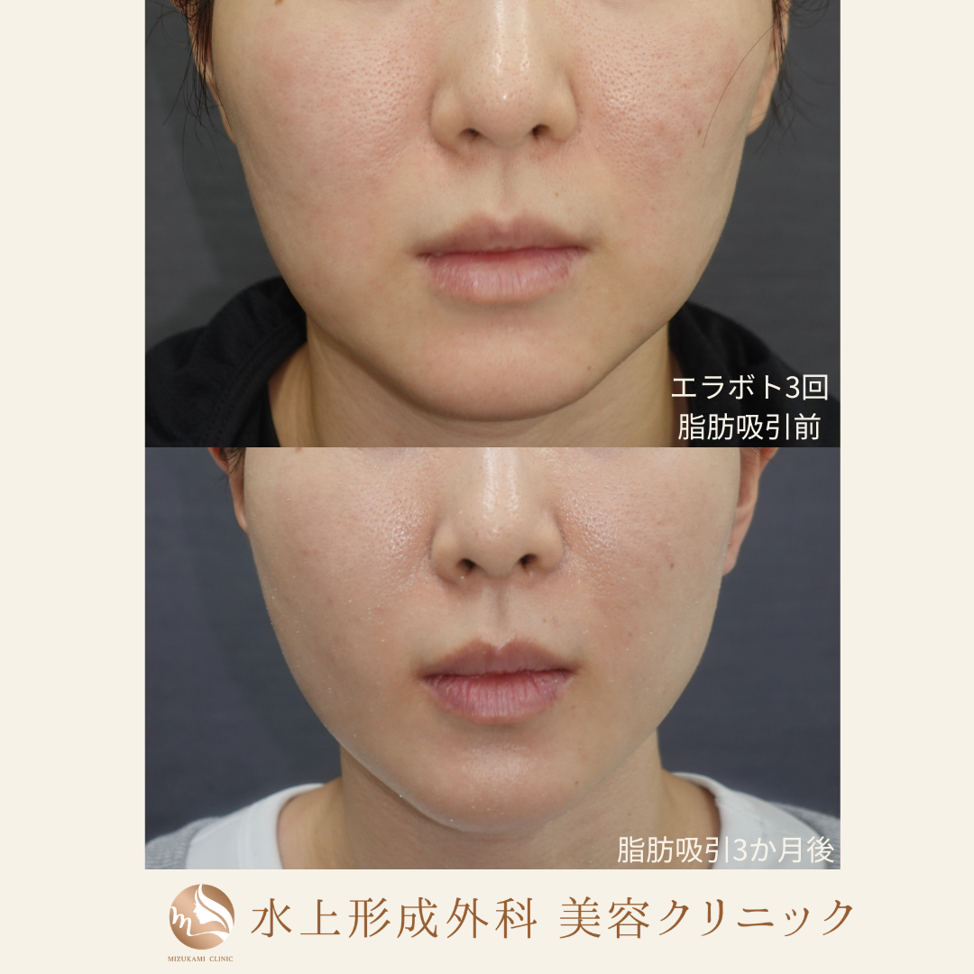 頬脂肪吸引＋エラボトックスの症例写真2