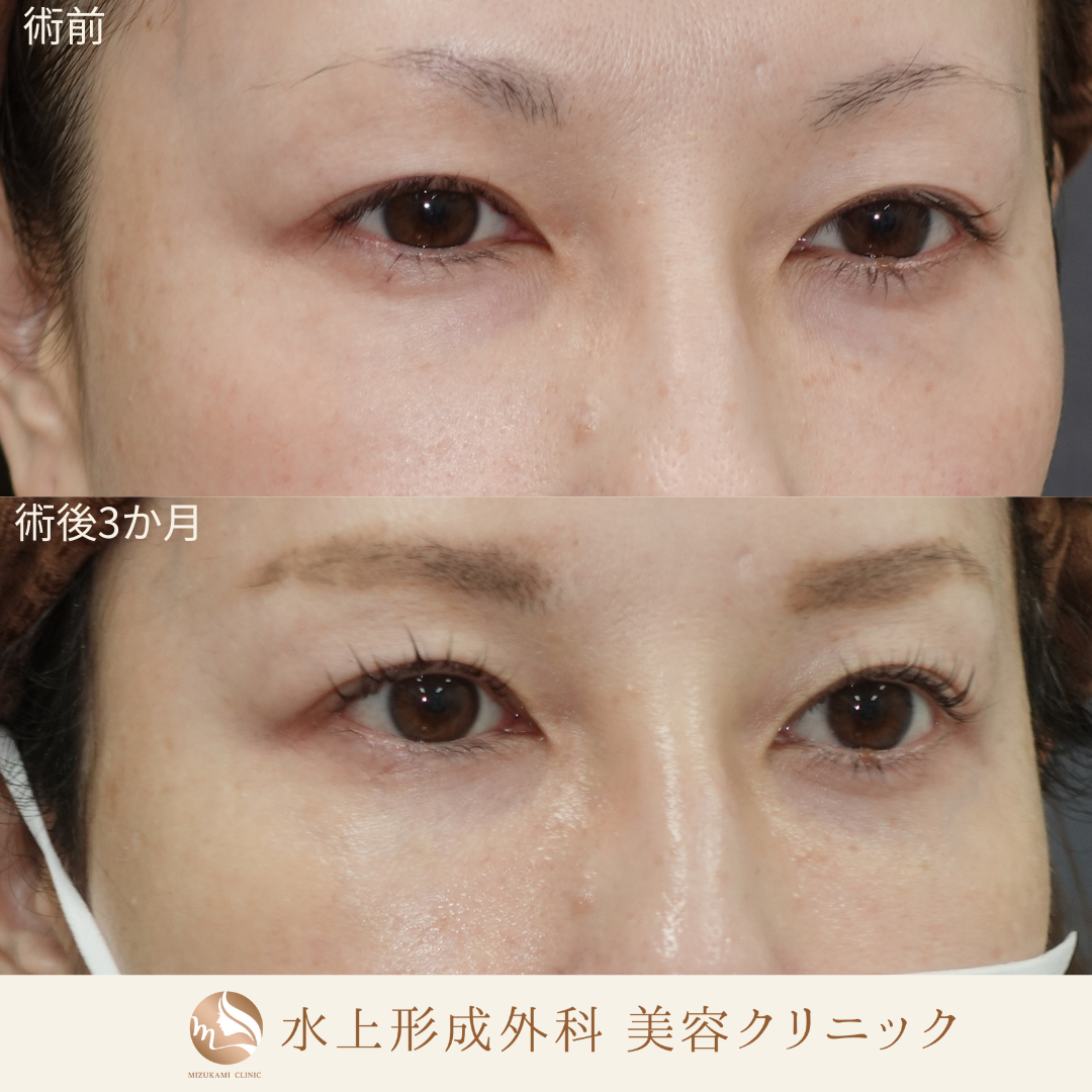 クマ取り（裏ハムラ）の症例写真2