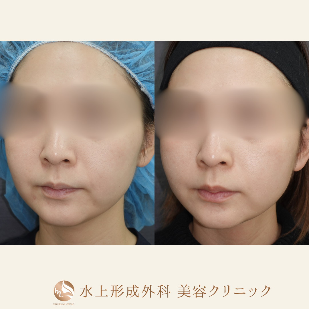 糸リフトの症例写真2