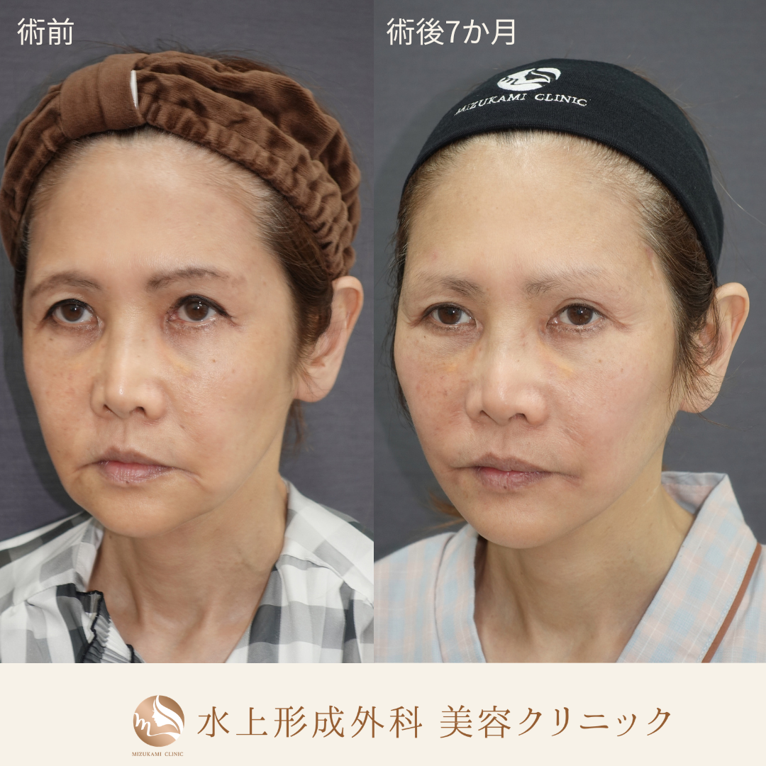 切開フェイスリフト（Deep Plane Facelift）