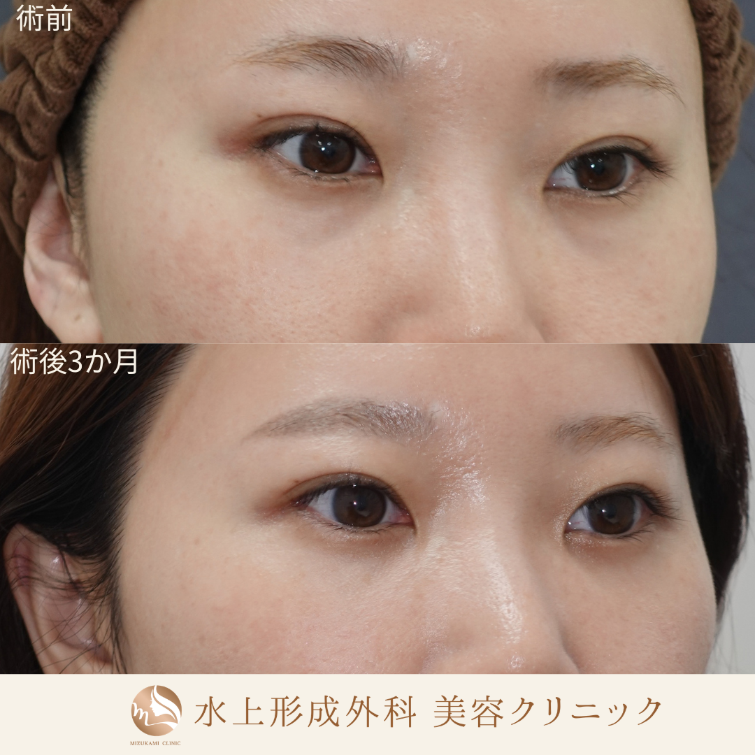 クマ取り（裏ハムラ）の症例写真6