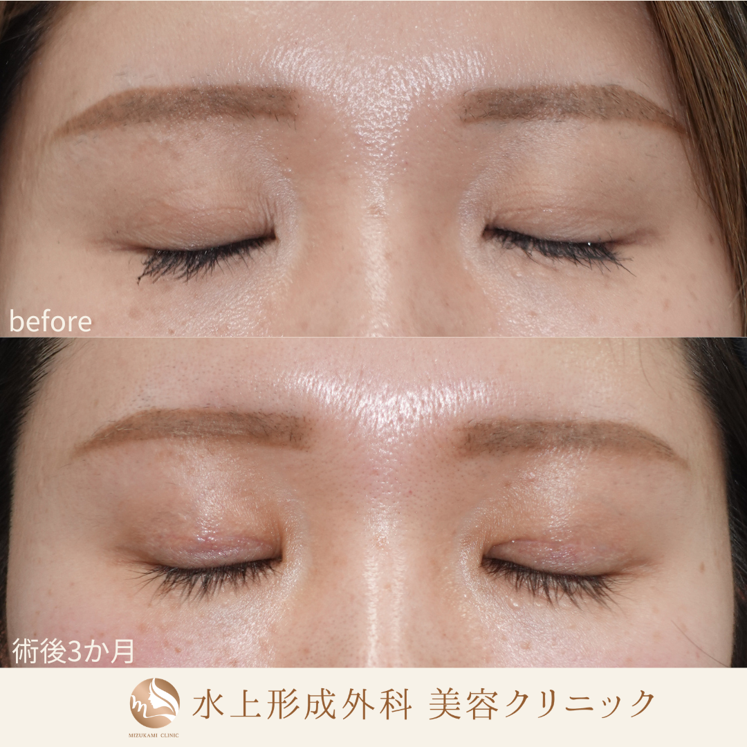 二重全切開法の症例写真2