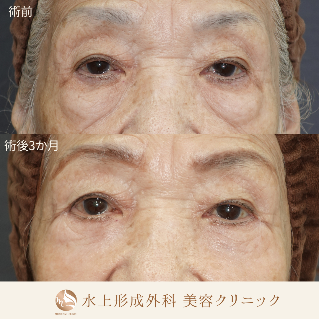 クマ取り（表ハムラ法）中顔面リフト（ミッドフェイスリフト）の症例写真2