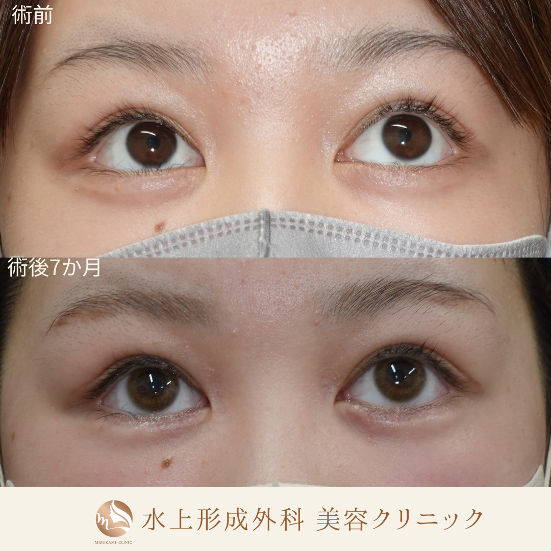 逆さまつ毛・睫毛内反症手術の症例写真2