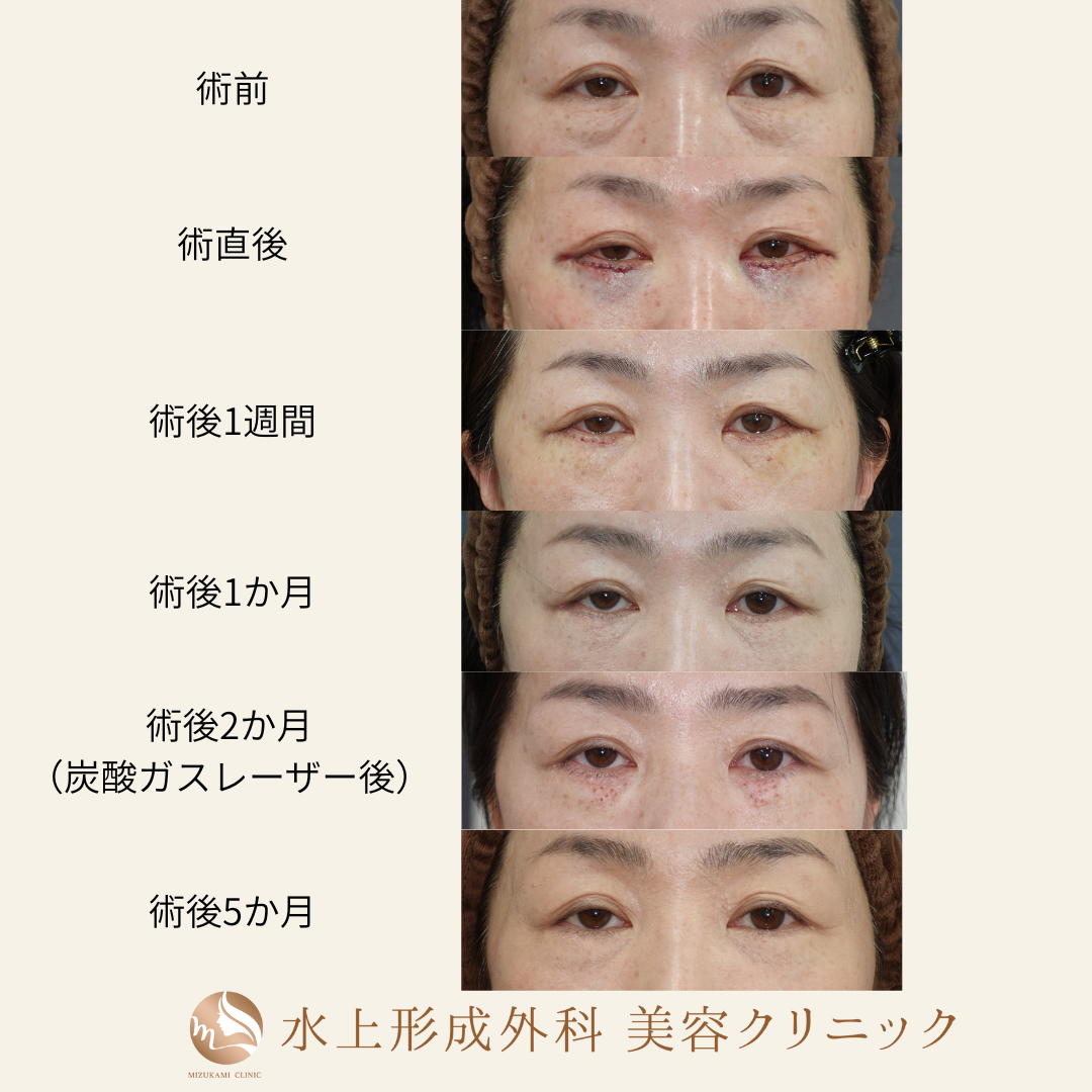 クマ取り（表ハムラ法）・汗管腫除去の症例写真3