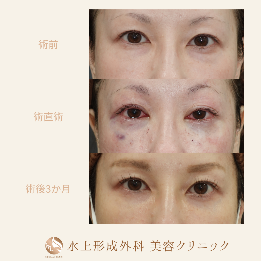 クマ取り（裏ハムラ）の症例写真3