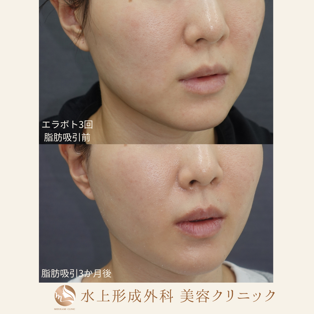 頬脂肪吸引＋エラボトックスの症例写真3