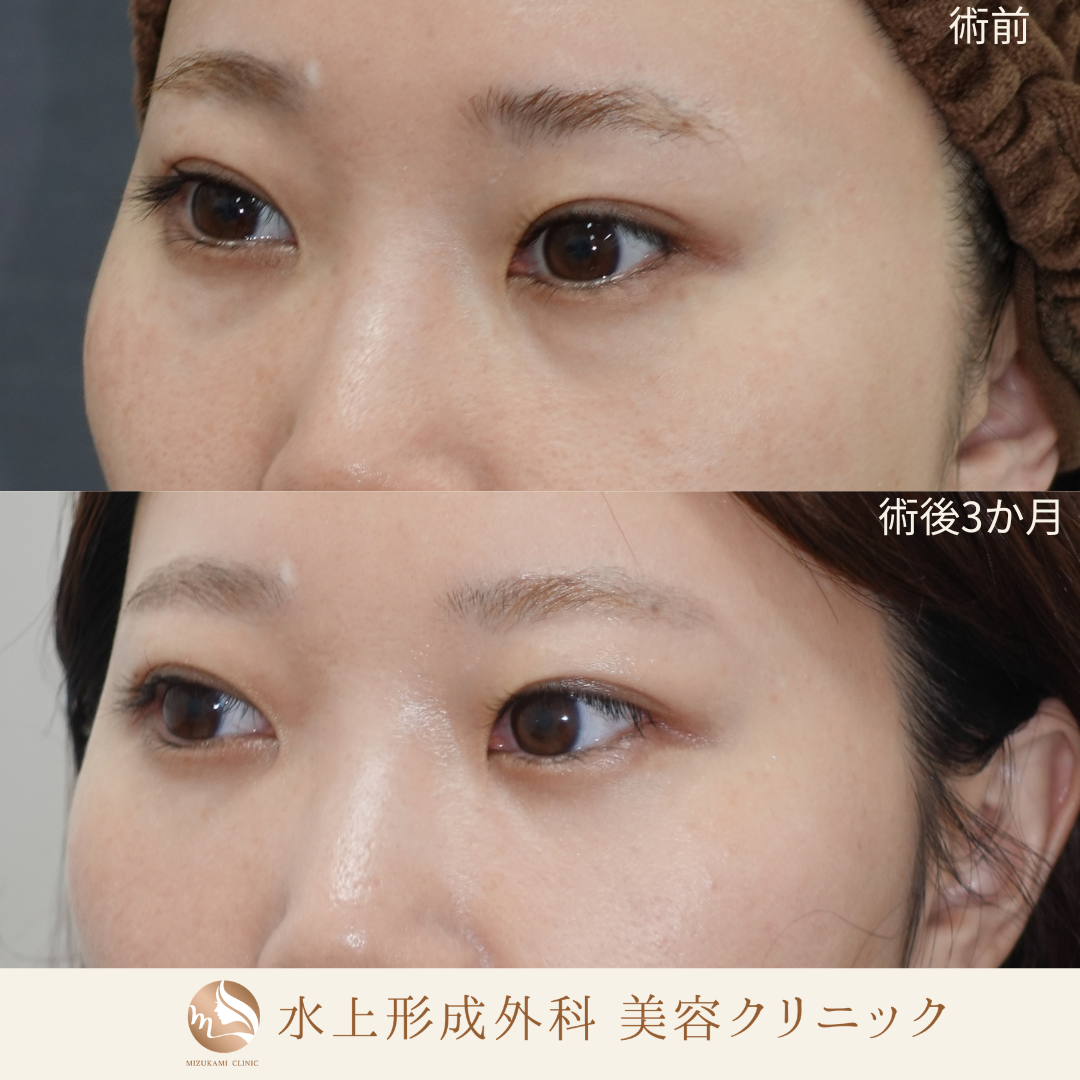 クマ取り（裏ハムラ）の症例写真3