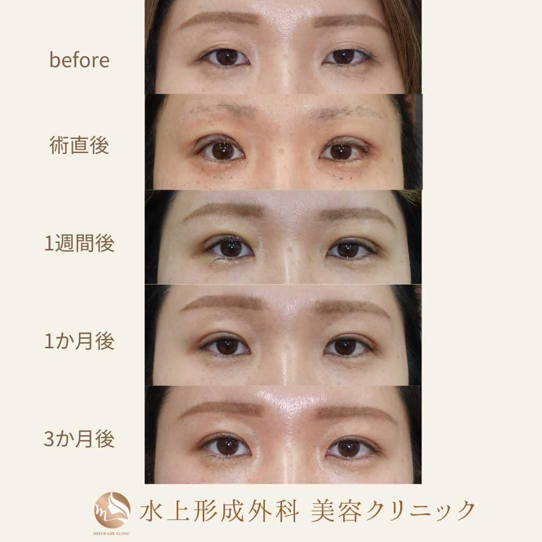 二重全切開法の症例写真3