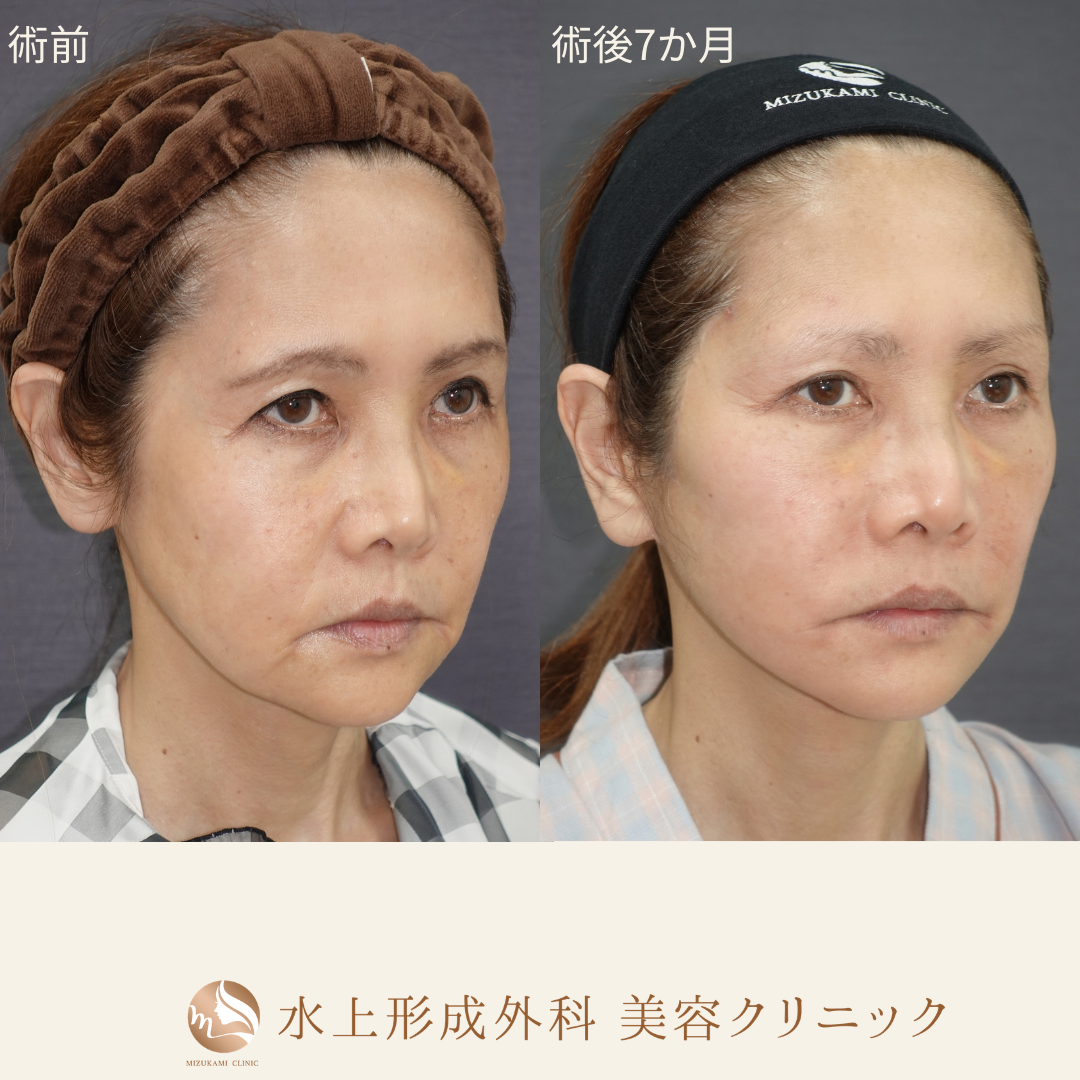 切開フェイスリフト（Deep Plane Facelift）の症例写真3