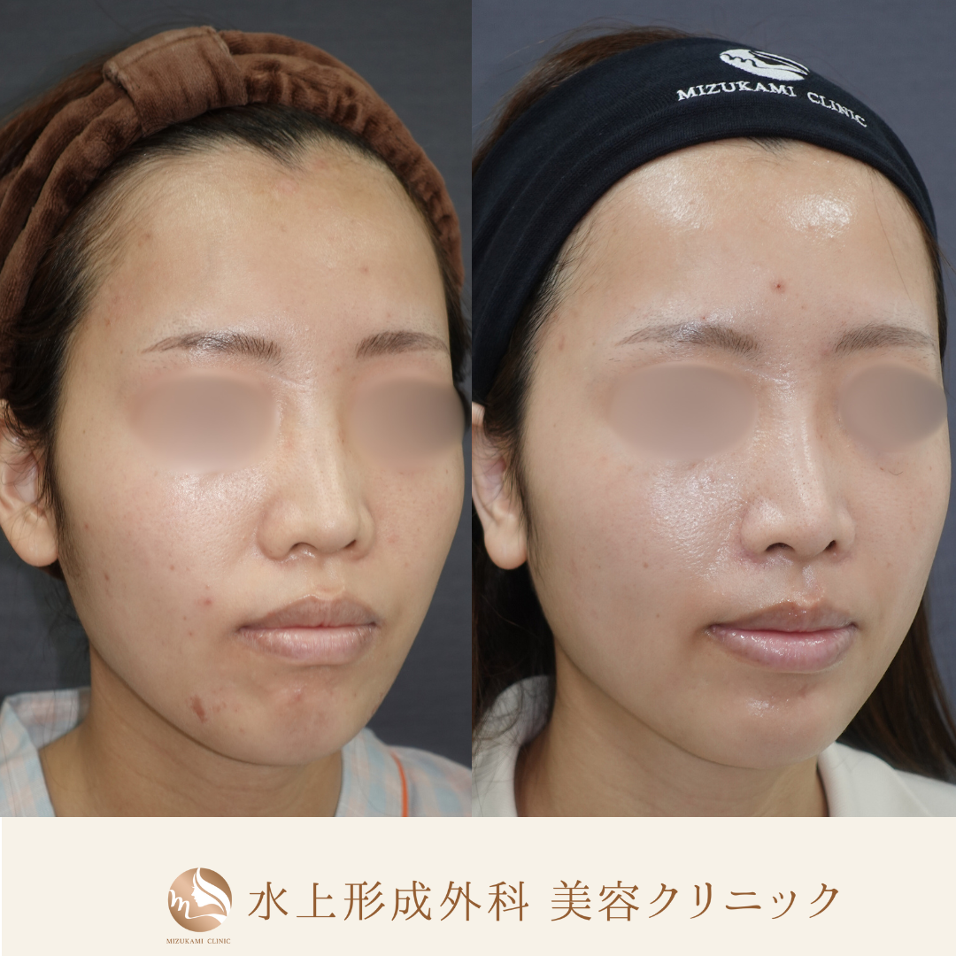 鼻フルコース（鼻中隔延長、鼻尖縮小、小鼻縮小外側法 、鼻翼基部プロテーゼ）の症例写真2