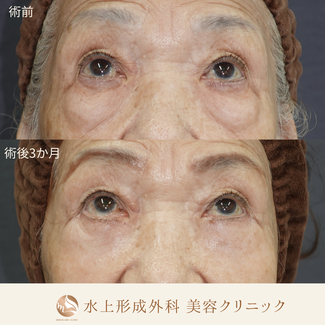 クマ取り（表ハムラ法）中顔面リフト（ミッドフェイスリフト）の症例写真4