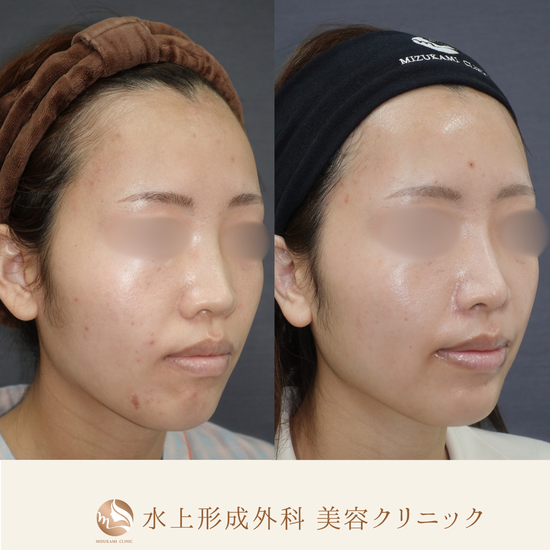 鼻フルコース（鼻中隔延長、鼻尖縮小、小鼻縮小外側法 、鼻翼基部プロテーゼ）の症例写真3