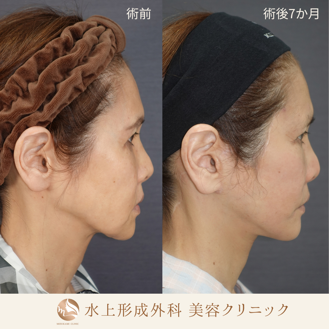 切開フェイスリフト（Deep Plane Facelift）の症例写真4