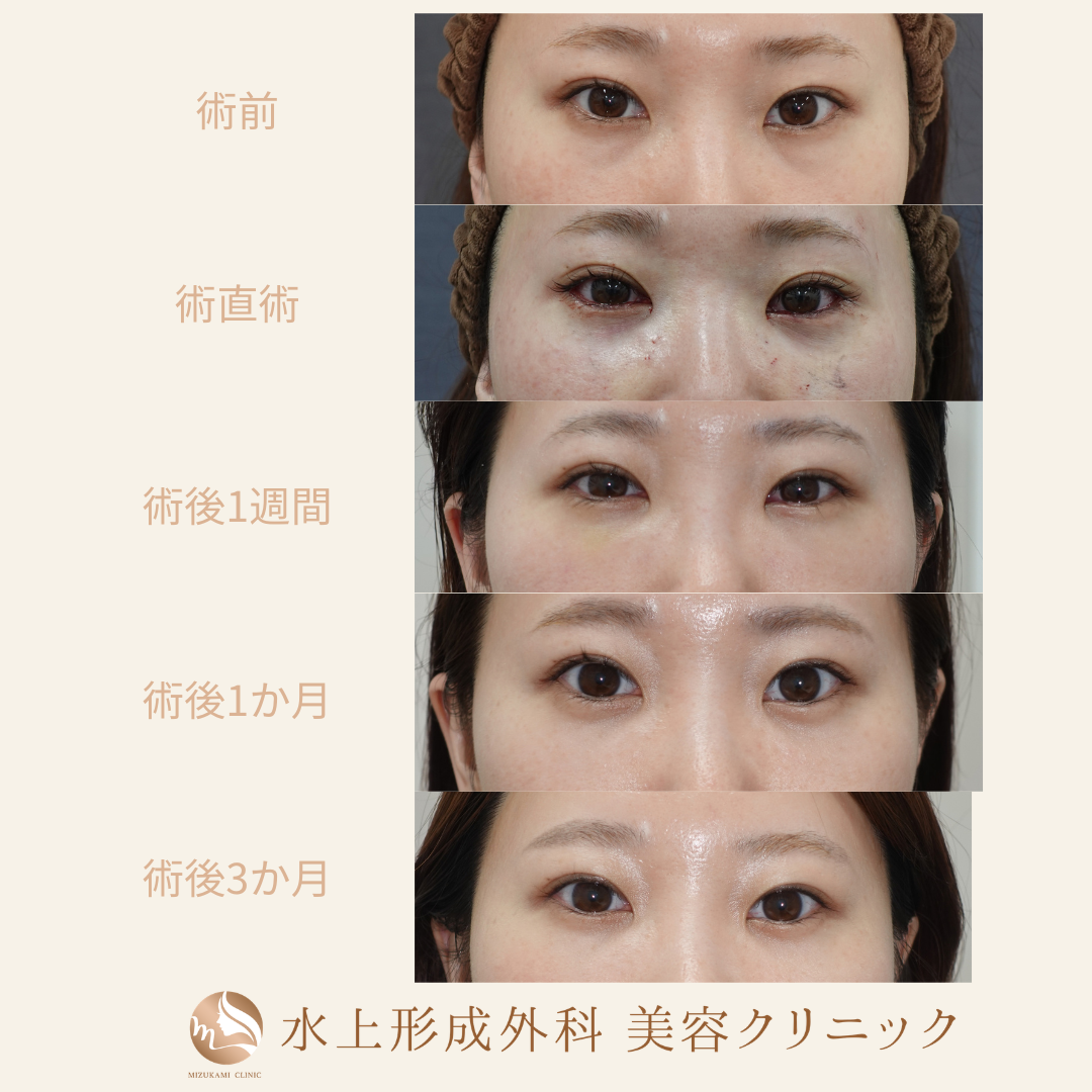 クマ取り（裏ハムラ）の症例写真7