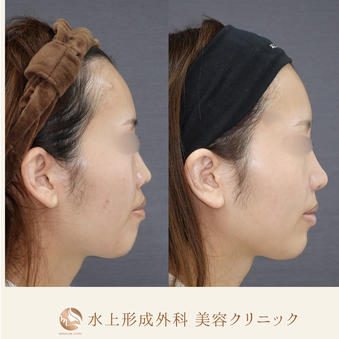 鼻フルコース（鼻中隔延長、鼻尖縮小、小鼻縮小外側法 、鼻翼基部プロテーゼ）の症例写真4