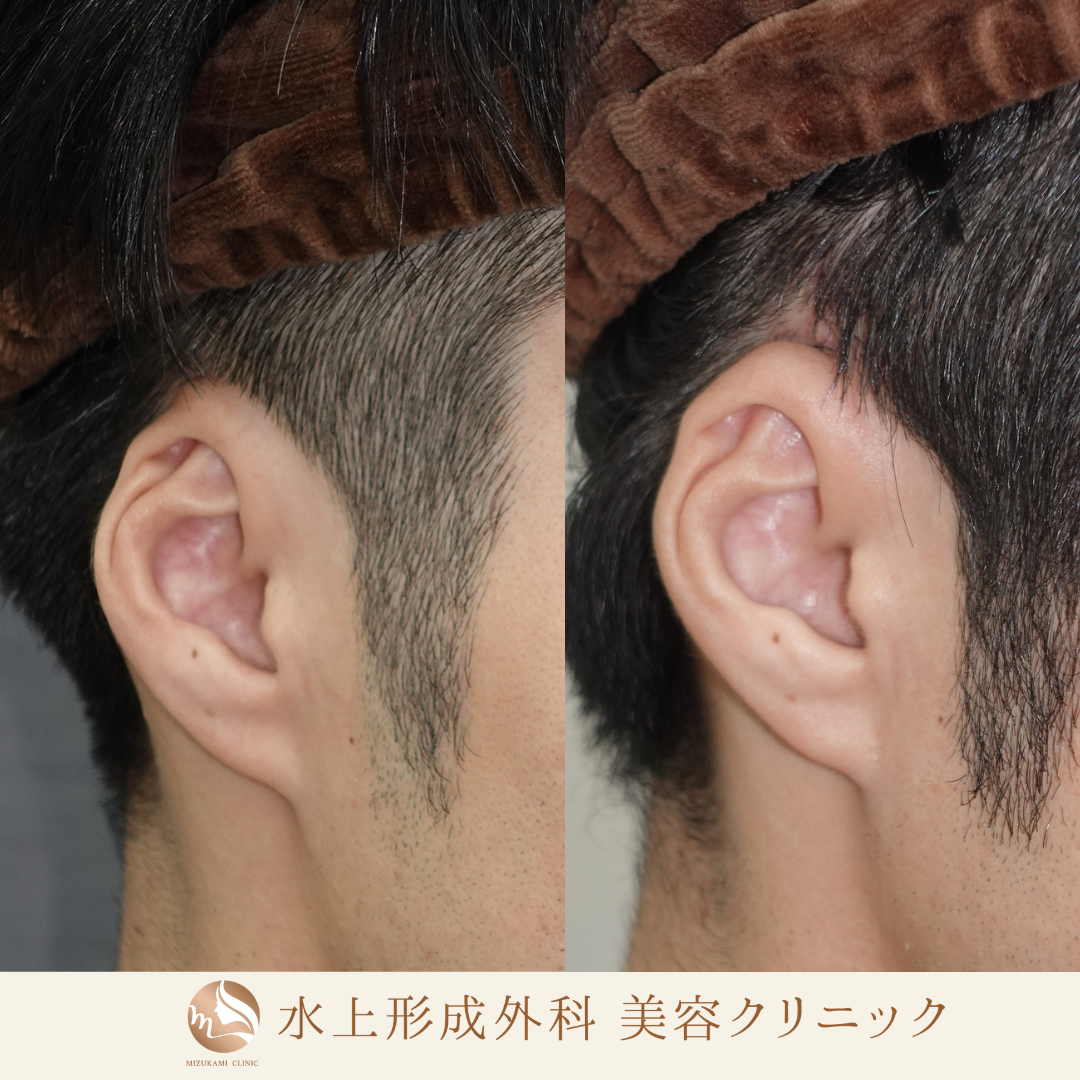 埋没耳形成手術