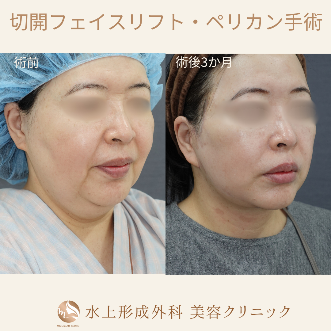 切開フェイスリフト・ペリカン手術