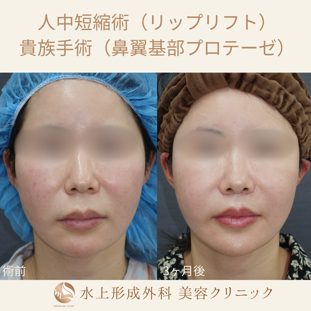人中短縮術（リップリフト）、貴族手術（鼻翼基部プロテーゼ）の症例写真2