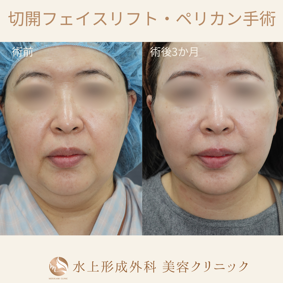 切開フェイスリフト・ペリカン手術の症例写真2