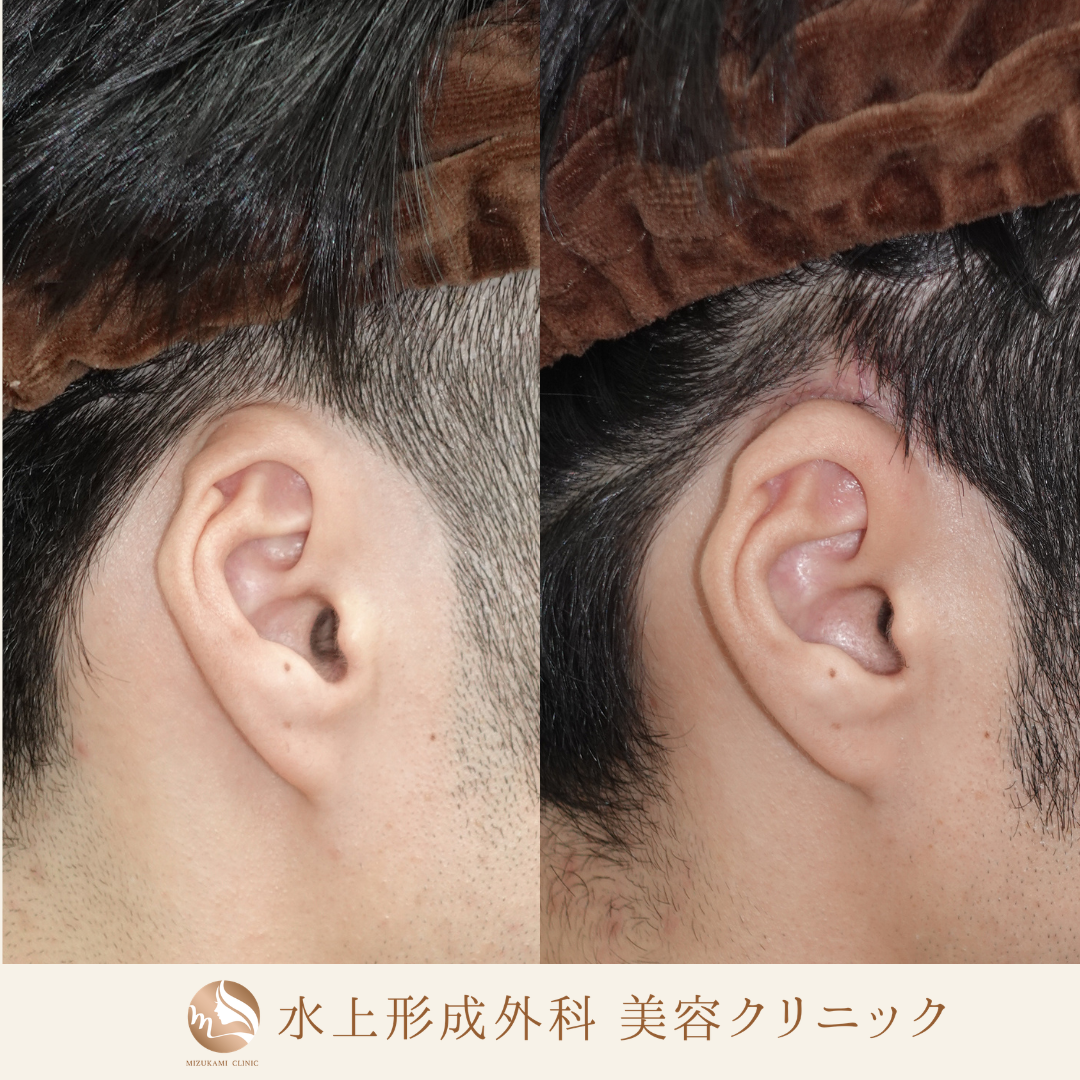 埋没耳形成手術の症例写真2